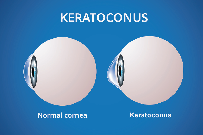 Diagram of normal cornea vs. cornea with keratoconus